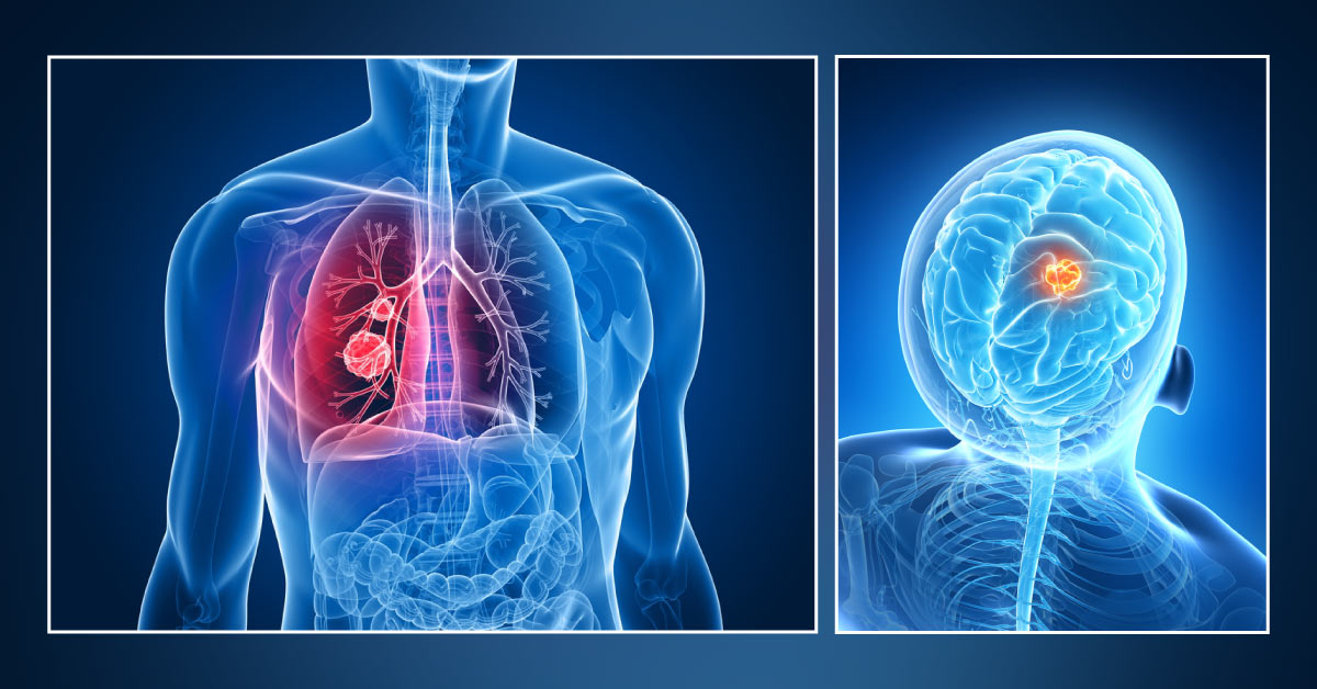 Lung Cancer Patients With Magnetic Resonance Patterns Of Brain Metastasis