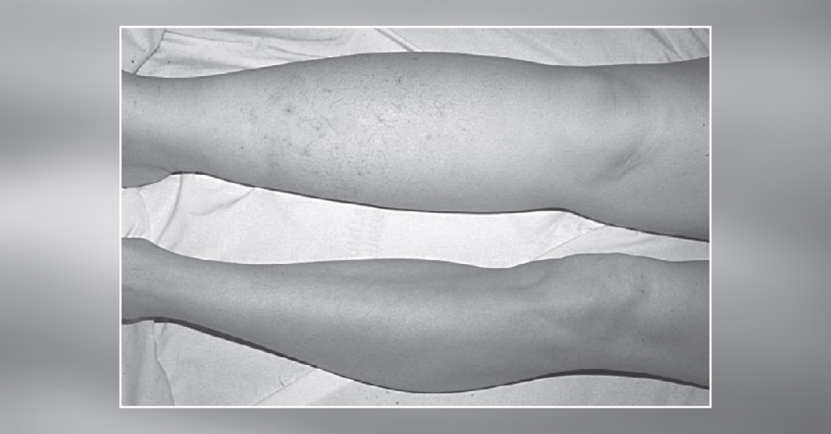 A Case of Unilateral Swollen Limb