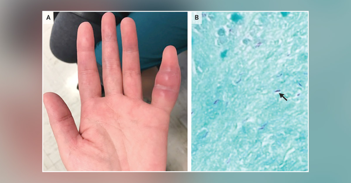 Spot This Rare Condition of a Swollen Finger