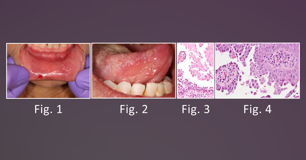Identify the Condition - A Patient with Multiple Intraoral Ulcerations