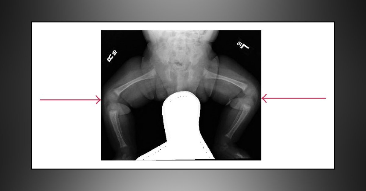 Case of an Infant with Lower Limb Immobility