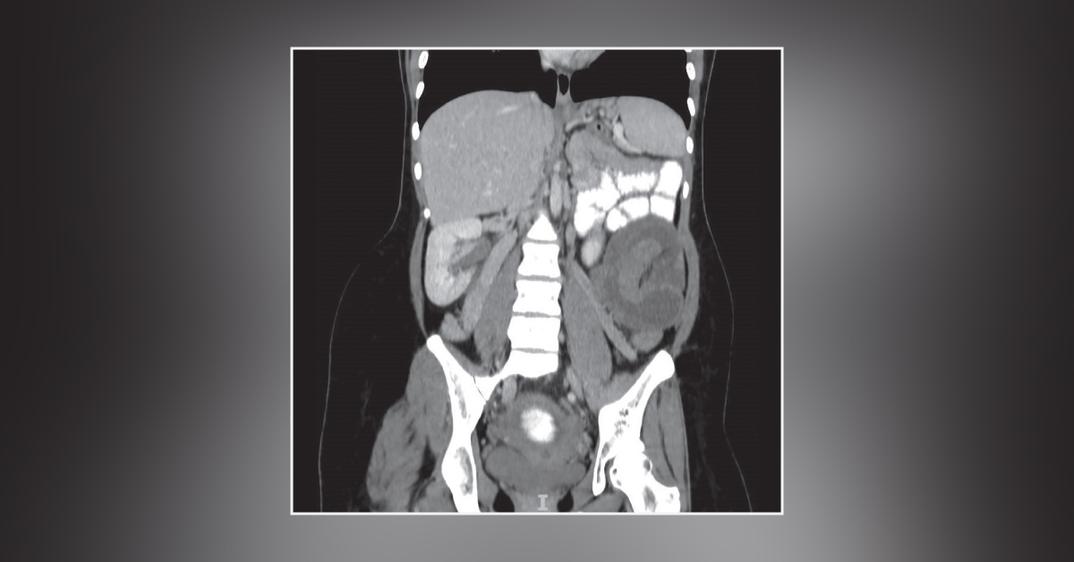What Is Causing Abdominal Pain in This Pregnant Woman?