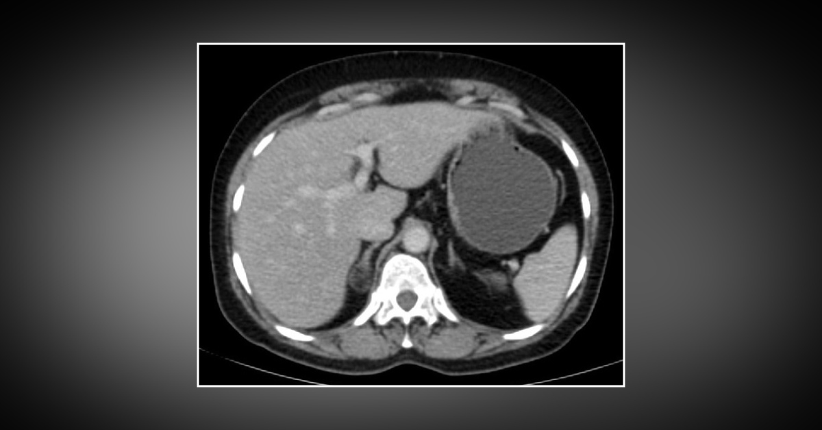 Case of B Cell Lymphoma