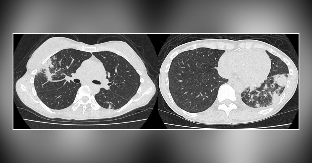 Do You Know the Clinical Characteristics of Pulmonary Nocardiosis?