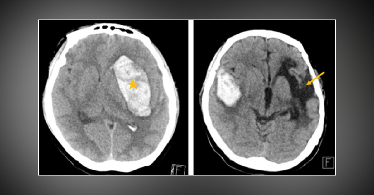A Case Of Acute Onset Of Postpartum Depression