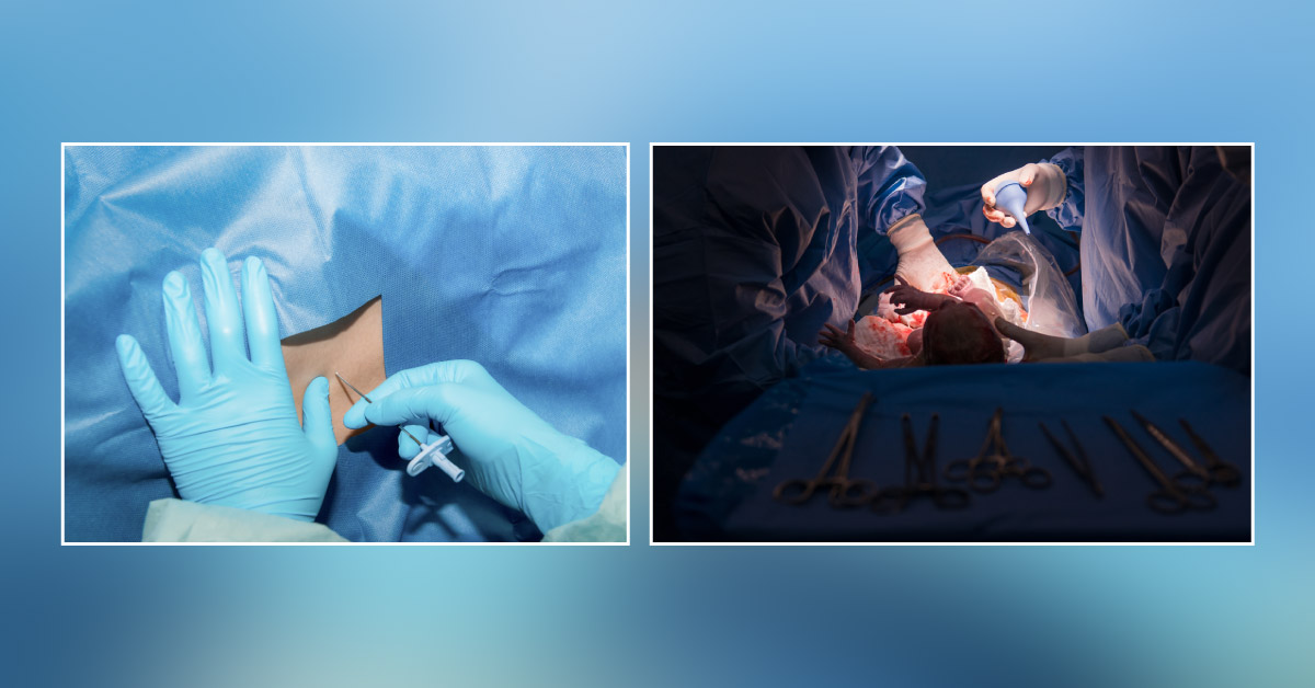 Minimally Invasive Spinal Anesthesia During Cesarean Section: How Safe Is It?