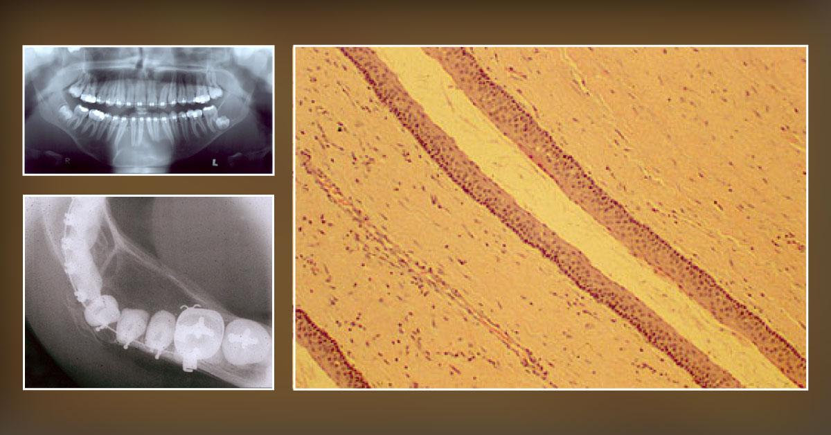 Swelling of the Lower Anterior Jaw