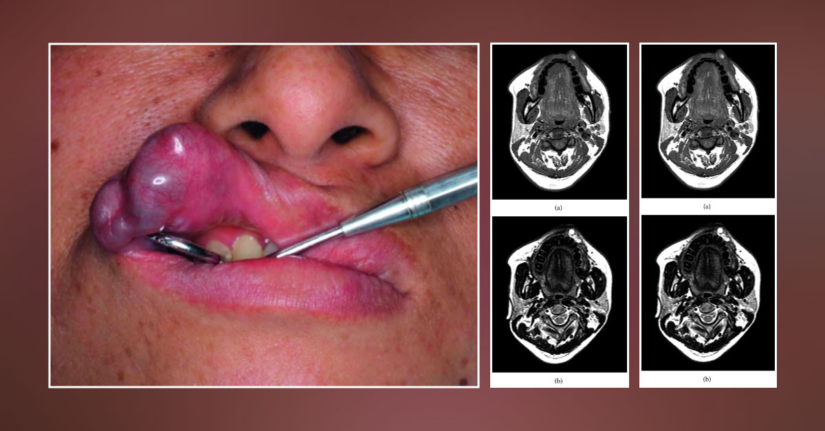Identify This Condition Which Developed After Lip Bite