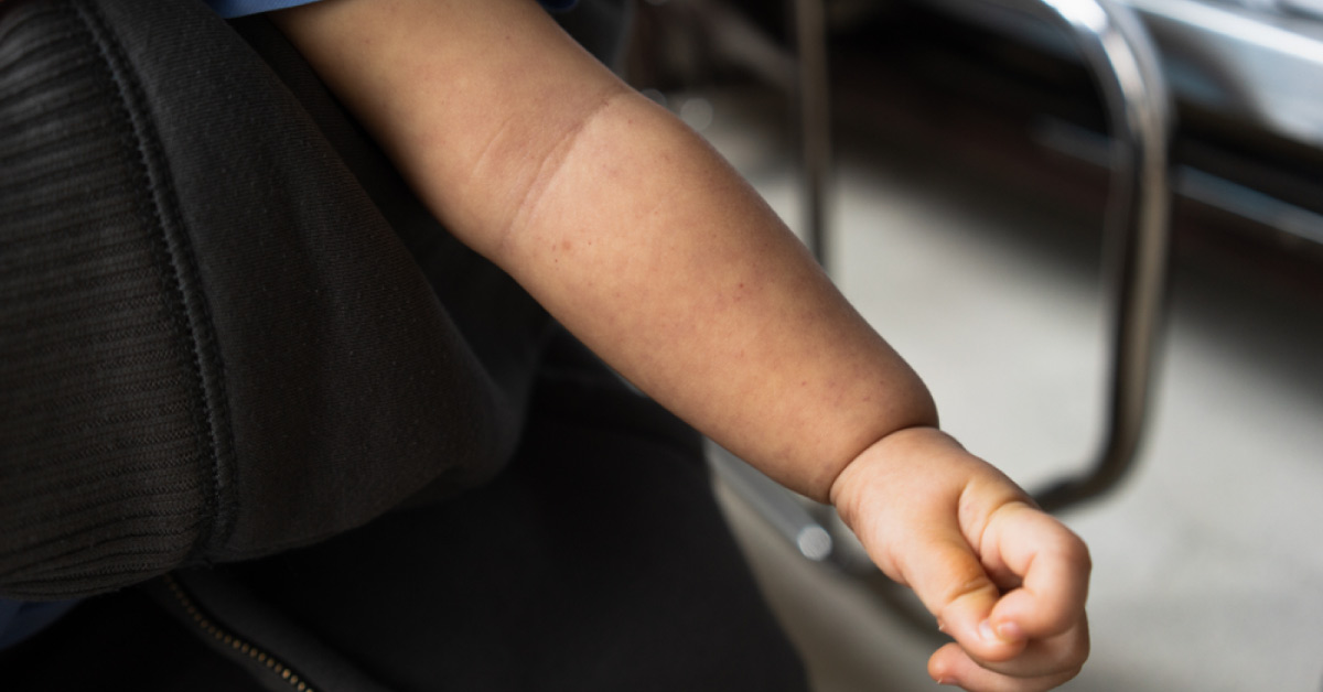 A Case of Neonatal Thrombocytopenia