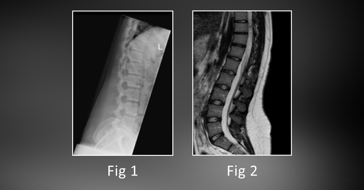 Unique Case of a Young Dancer with Back Pain