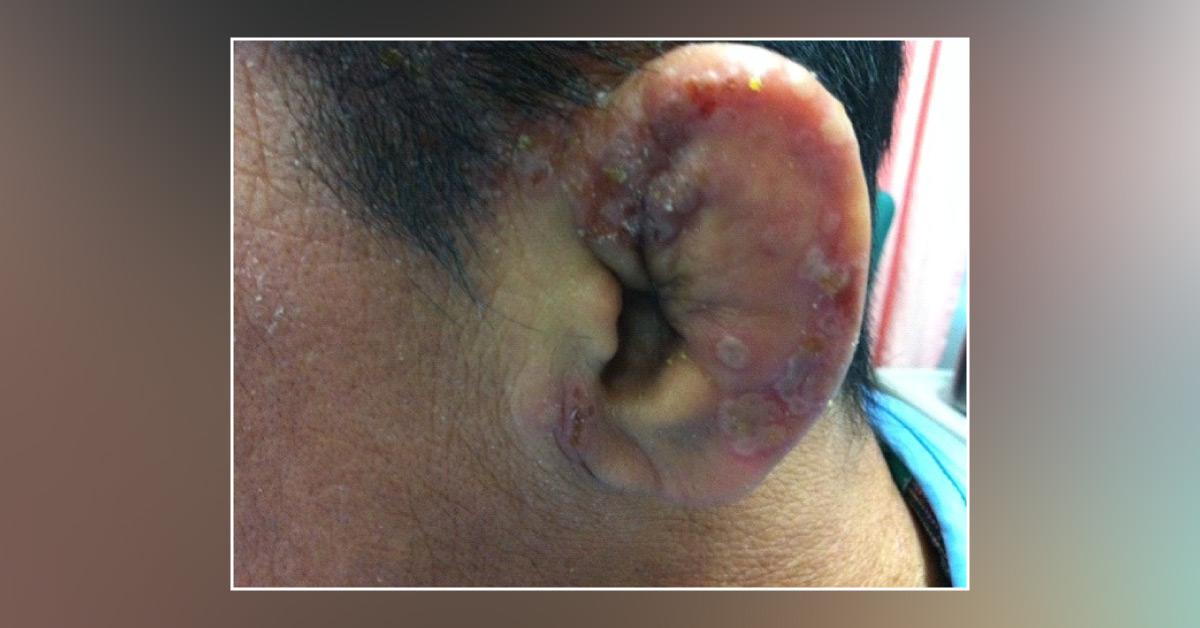 Identify This Condition of Painful Ears