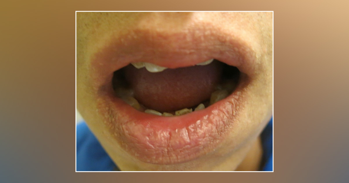 Multiple Spots over the Lips