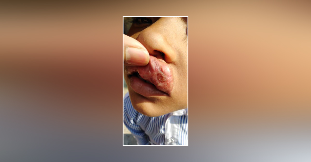 Case Of Swelling Over Upper Lip