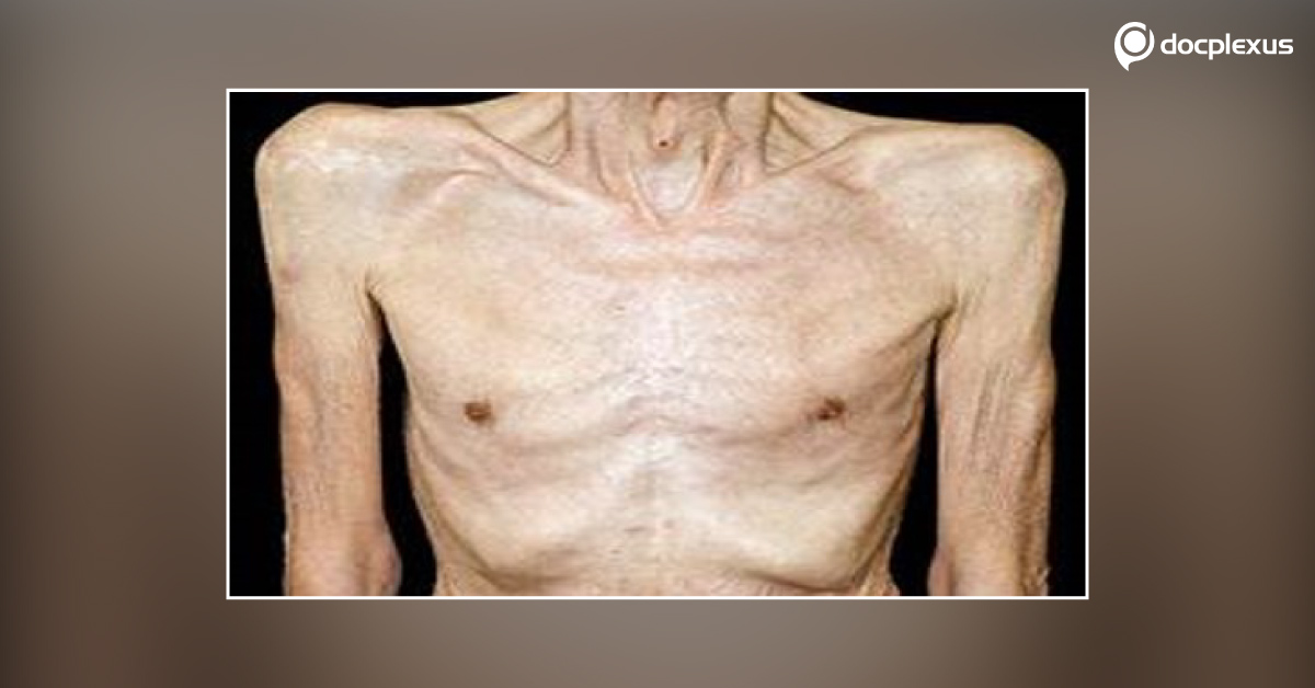 Powdered Nutritional Supplement For Cachexia: Community Viewpoint