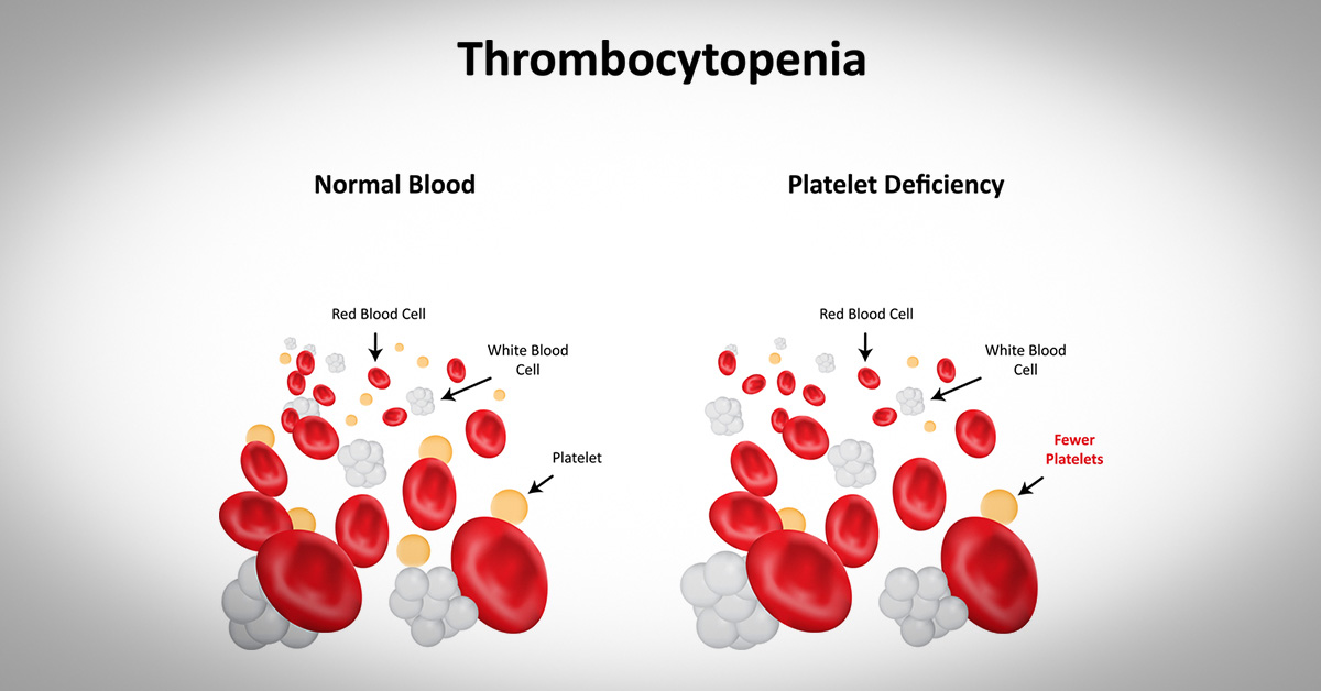 Causes Of Platelet Destruction