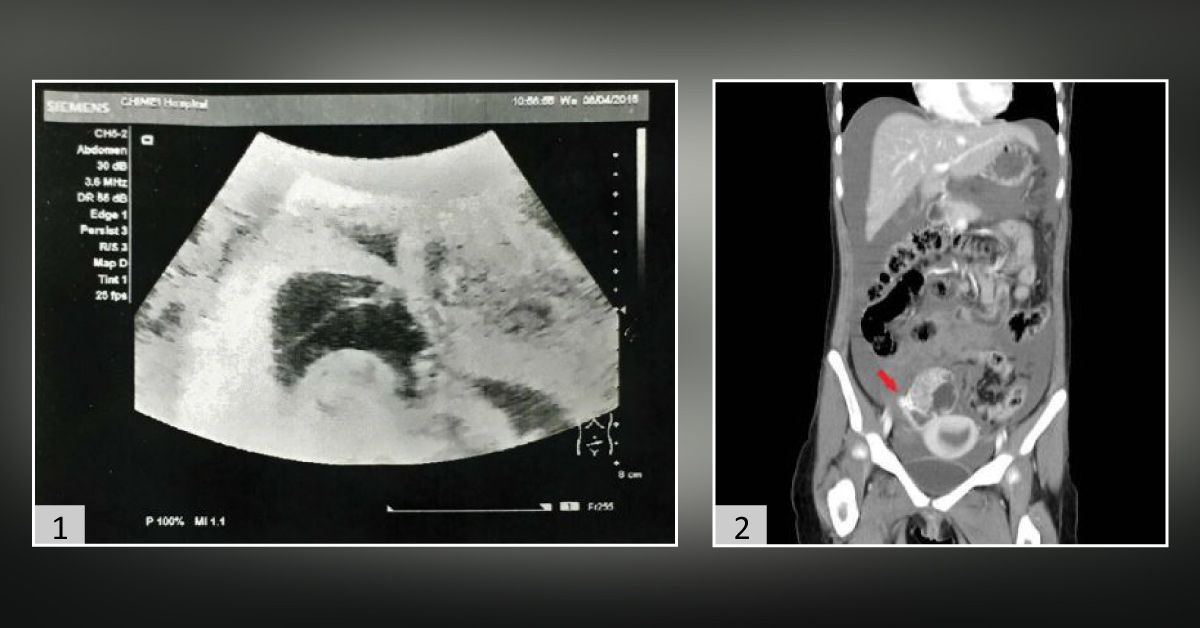 A Case of Severe Diffuse Abdominal Pain: What's Your Diagnosis?