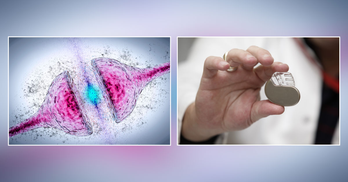Researchers Develop Brain 'Pacemaker' To Treat Epilepsy, Parkinson's