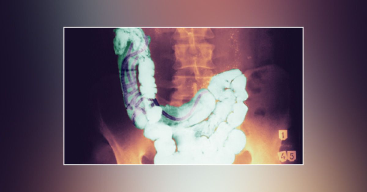Case of Abdominal Cramping and a Foreign Body in the Stool