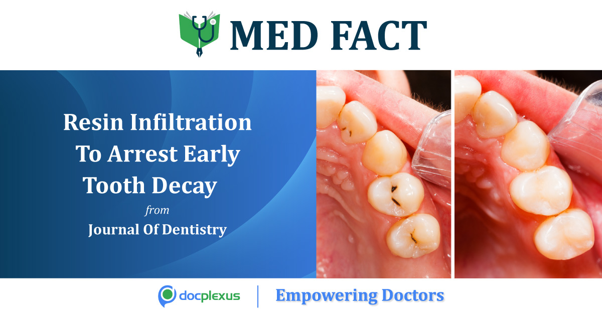 Resin Infiltration As Adjunct Therapy For High Caries Risk