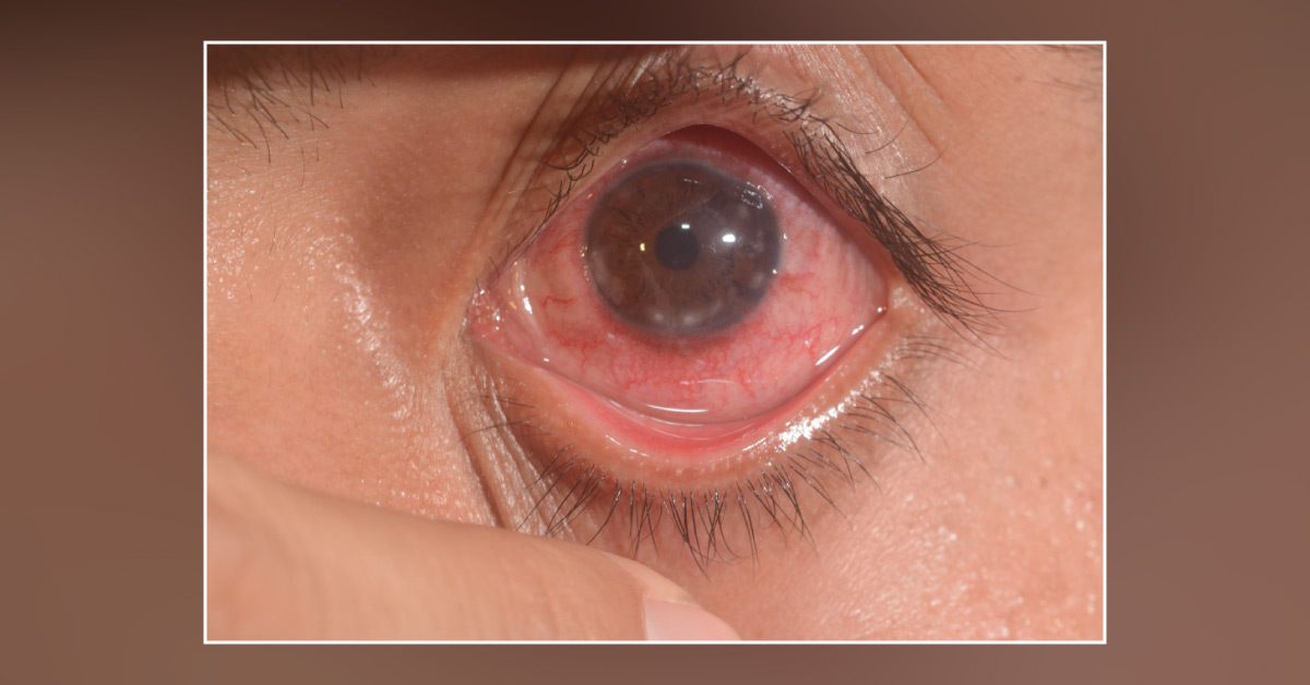Vernal Plaque Of Shield Ulcer