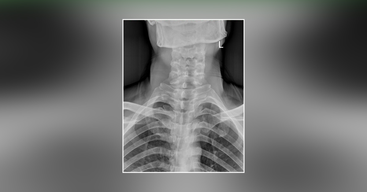 What Is Evident From This X-Ray?
