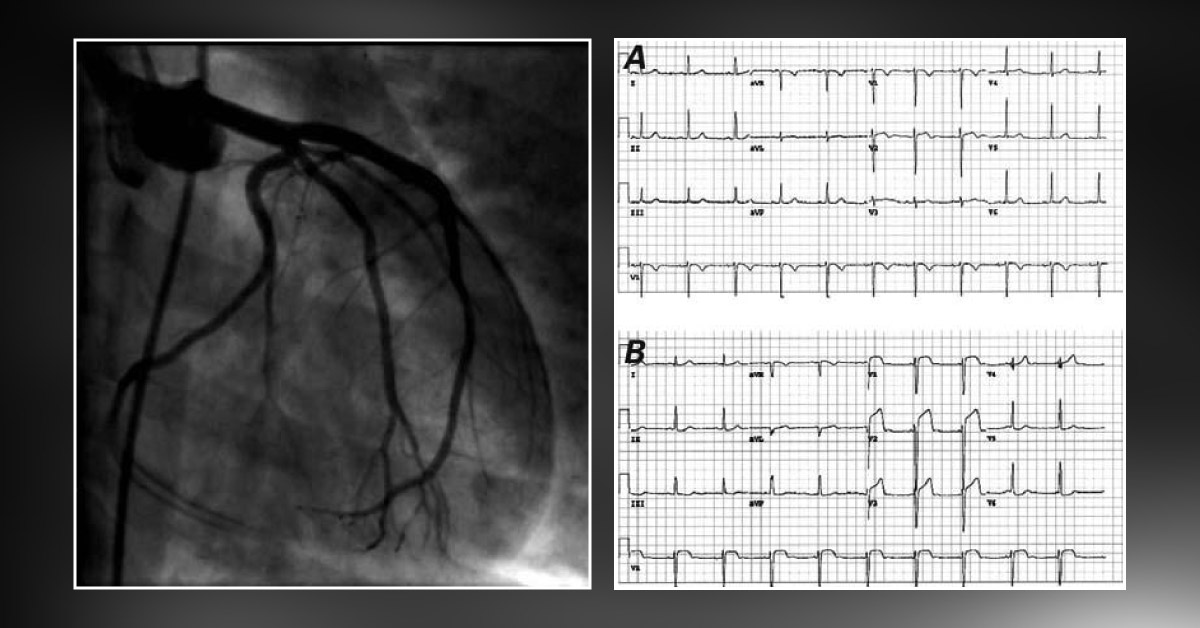 Case Of Acute Chest Pain