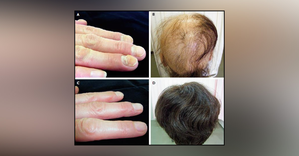 Case of Brittle Nails and Hair Loss