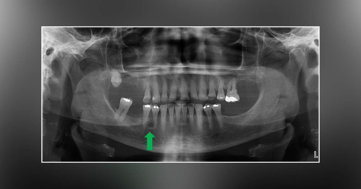 Identify This Inter-radicular Radiolucency