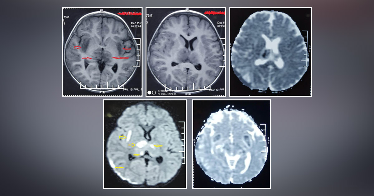 Interesting Case Of Encephalitis
