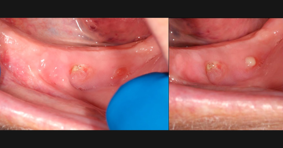 These Mouth Sores are Gradually Worsening