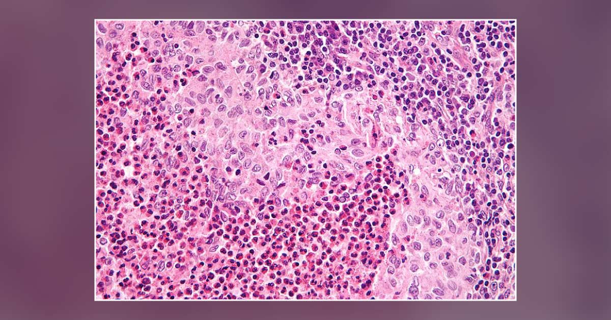 Treatment of Langerhans Cell Histiocytosis With A Modified Risk‐Adapted Protocol