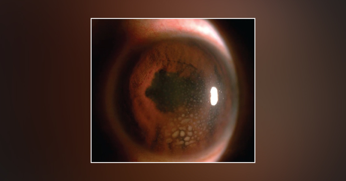 Brief On Causes Of Granulomatous Panuveitis