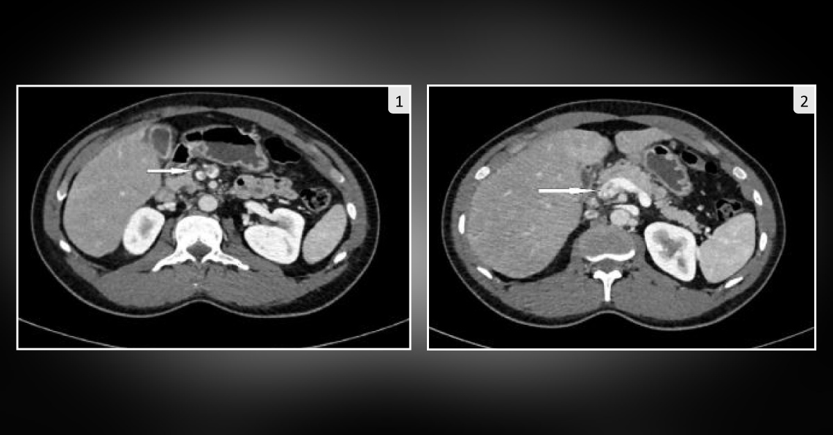 A Case of Abdominal Pain: Can You Diagnose It?