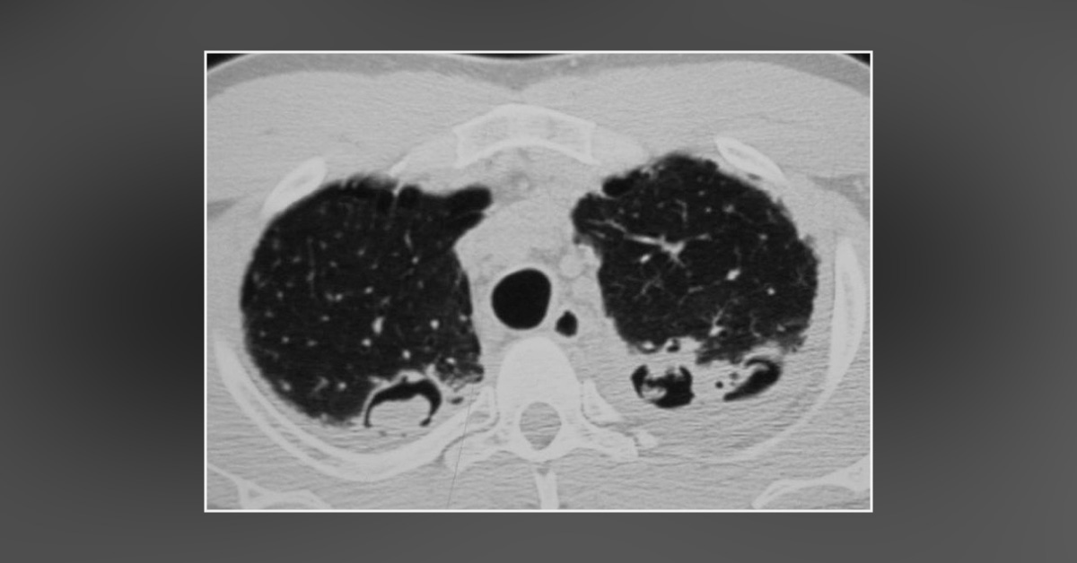 A Case Of Hemoptysis With A History Of Sarcoid