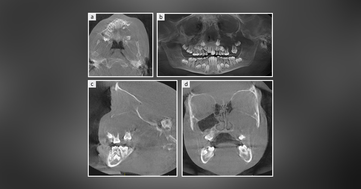 Case of a Young Girl with a Swelling on the Left Cheek
