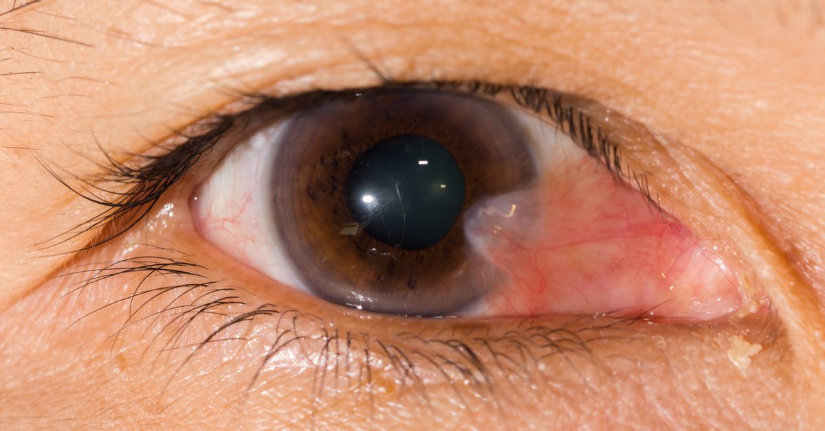 Some Of The Rare Complications Of Pterygium Surgery