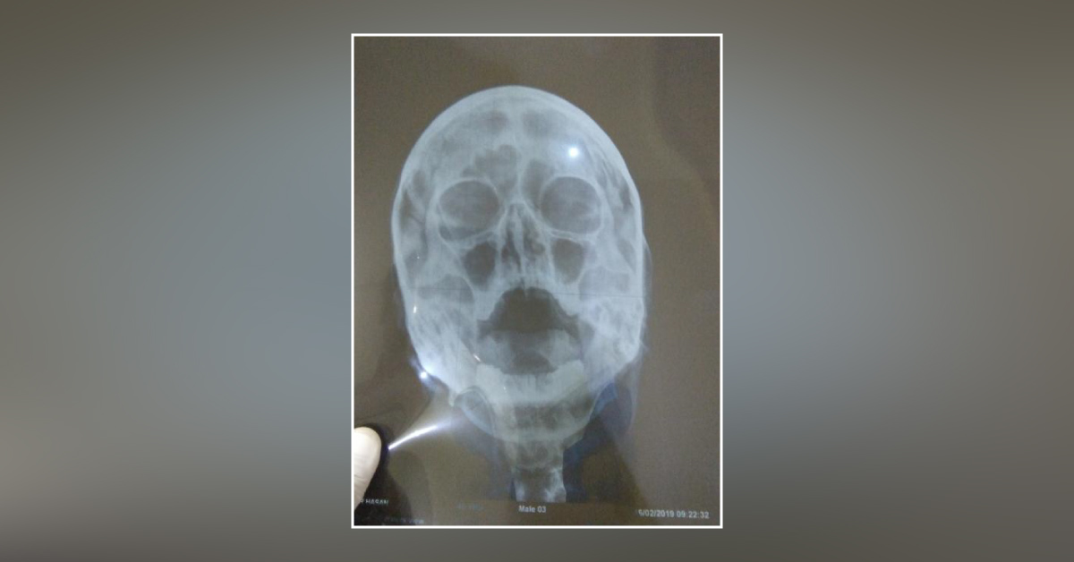 Case Of Nasal Obstruction