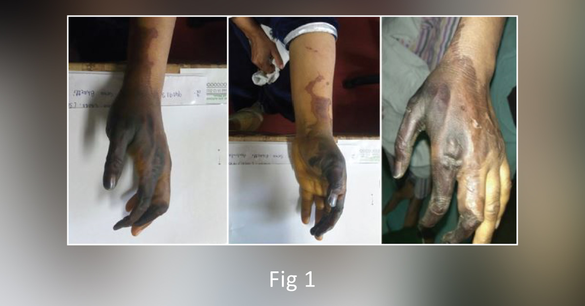 Digital Gangrene: A Cocktail Therapy-induced Mishap