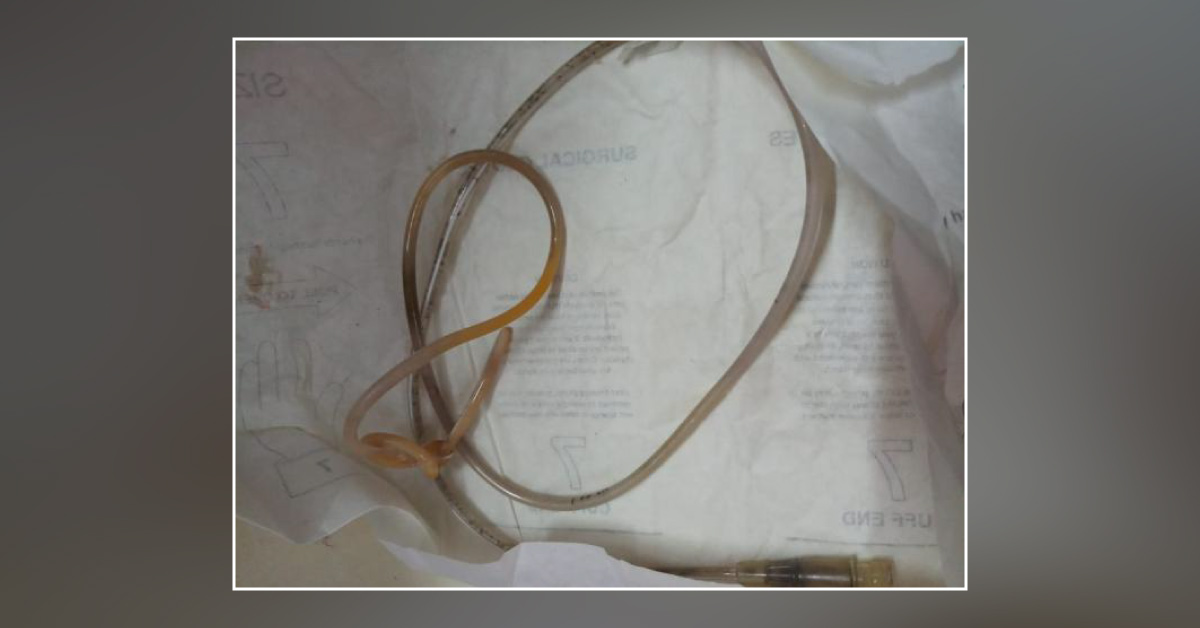 Difficult Ryles Tube
