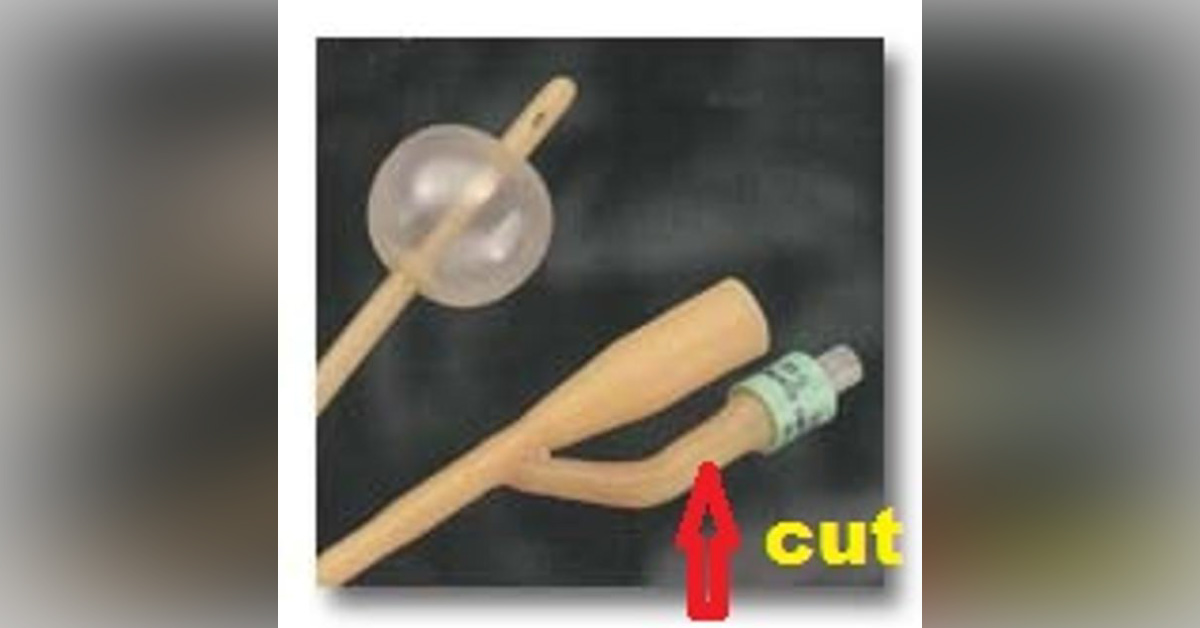 Retained Foleys Catheter In Child