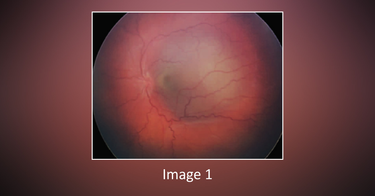 A Case of Pediatric Atypical Fundus Mass