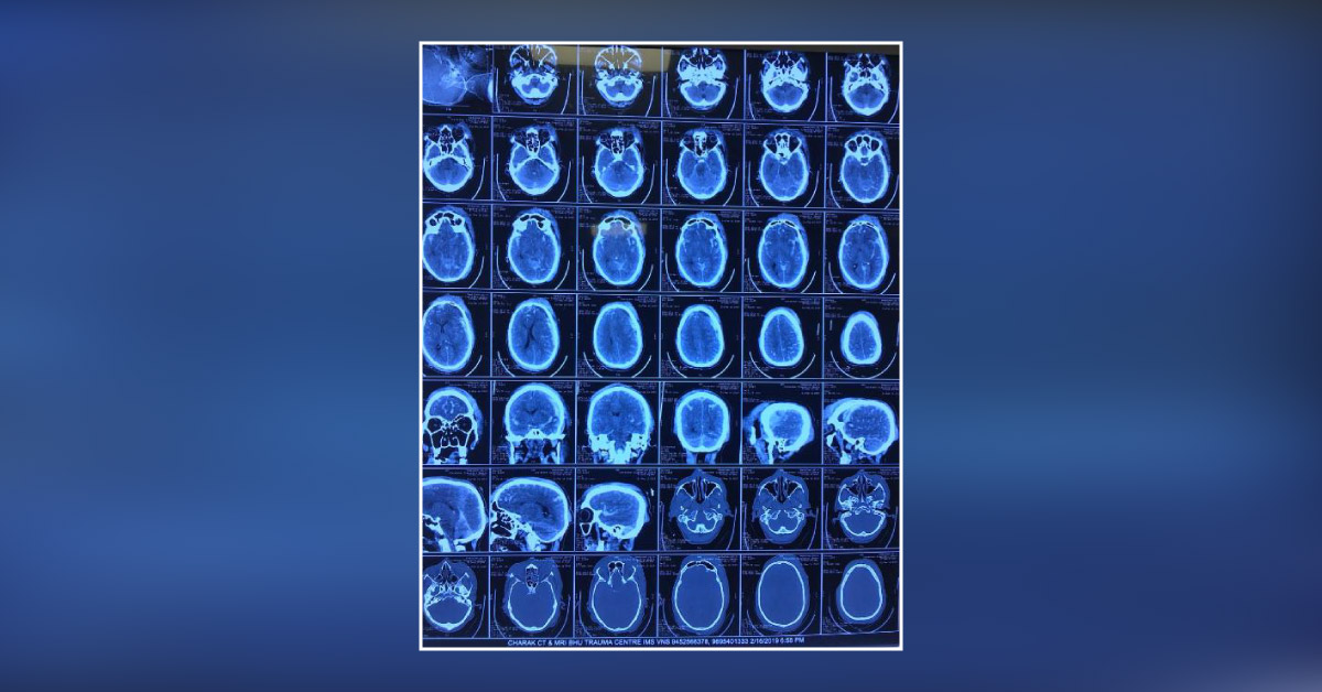 Severe Traumatic Brain Injury Management