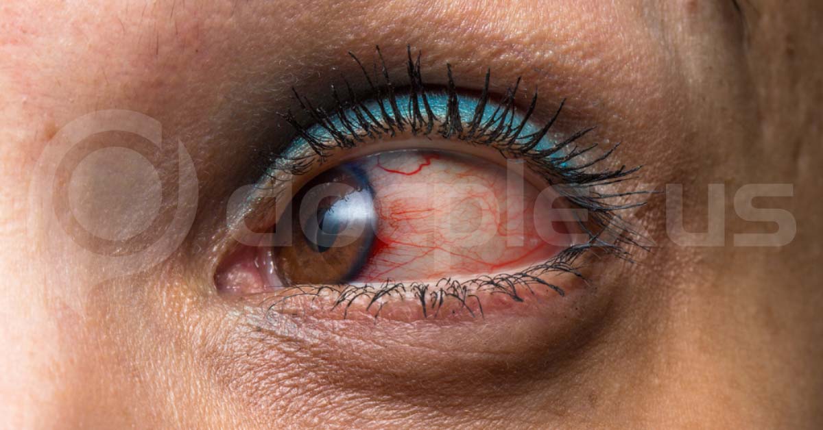 Ocular Manifestations Of Rheumatoid Arthritis
