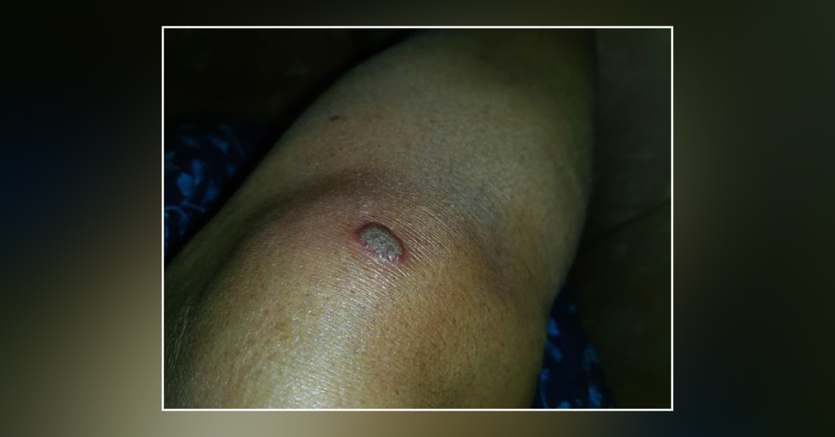 Suggestions On Diagnosis And Treatment Of Choice For Derma Issue
