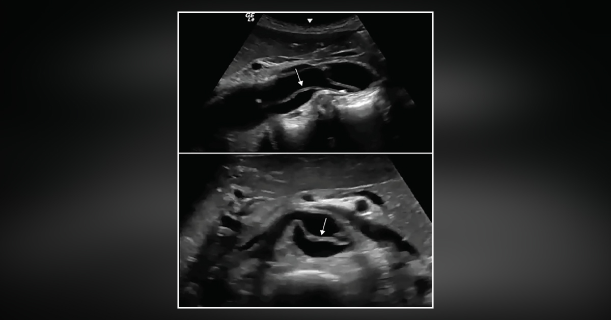 Sudden Onset of Atraumatic Right Lower Extremity Pain - What's Your Diagnosis?