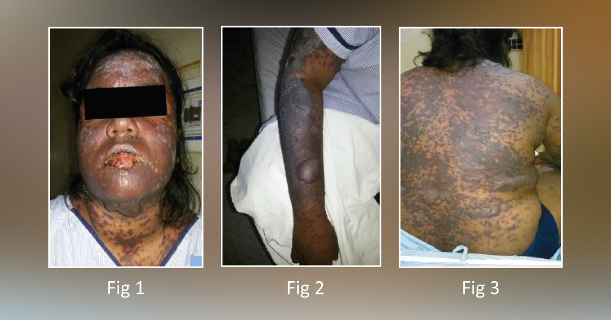 A Fatal Case Of Etoricoxib‑Induced Necrolysis