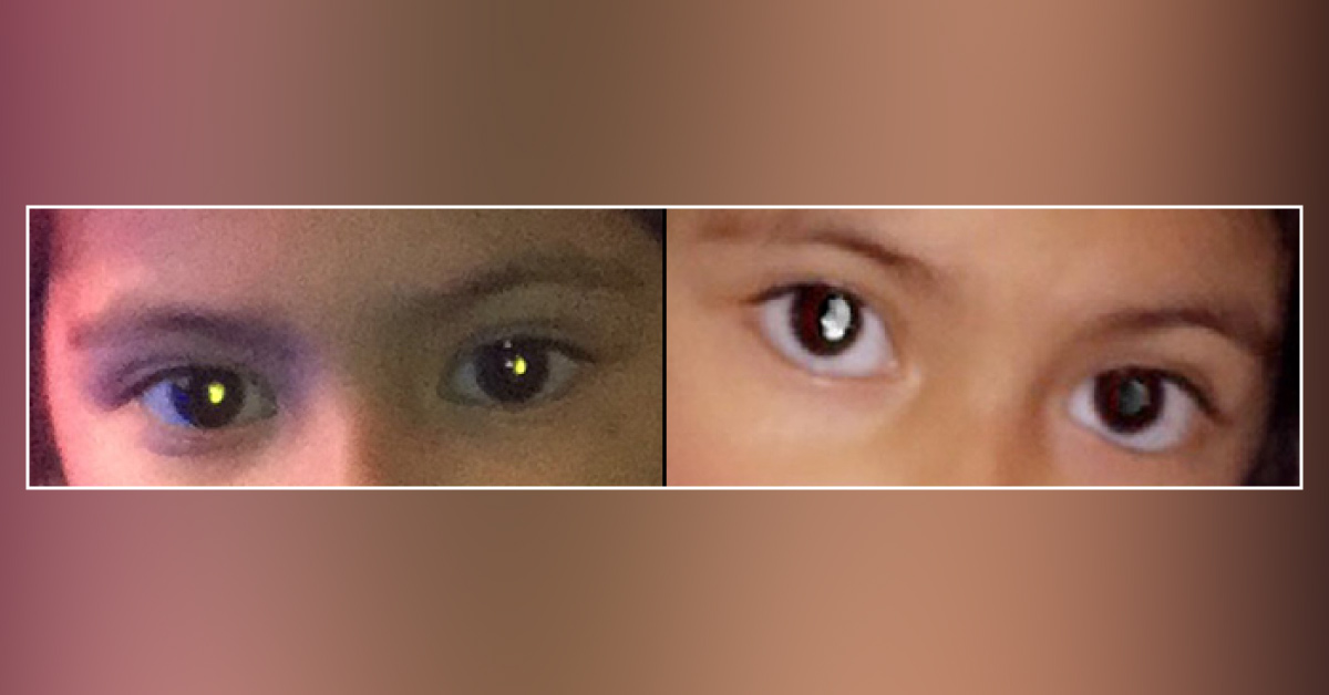 A Girl with White Eyes in Photos