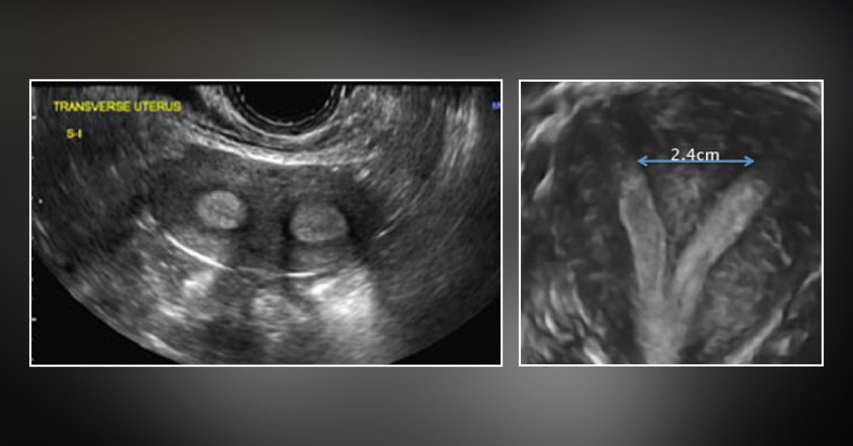 A Case of Multiple Miscarriages