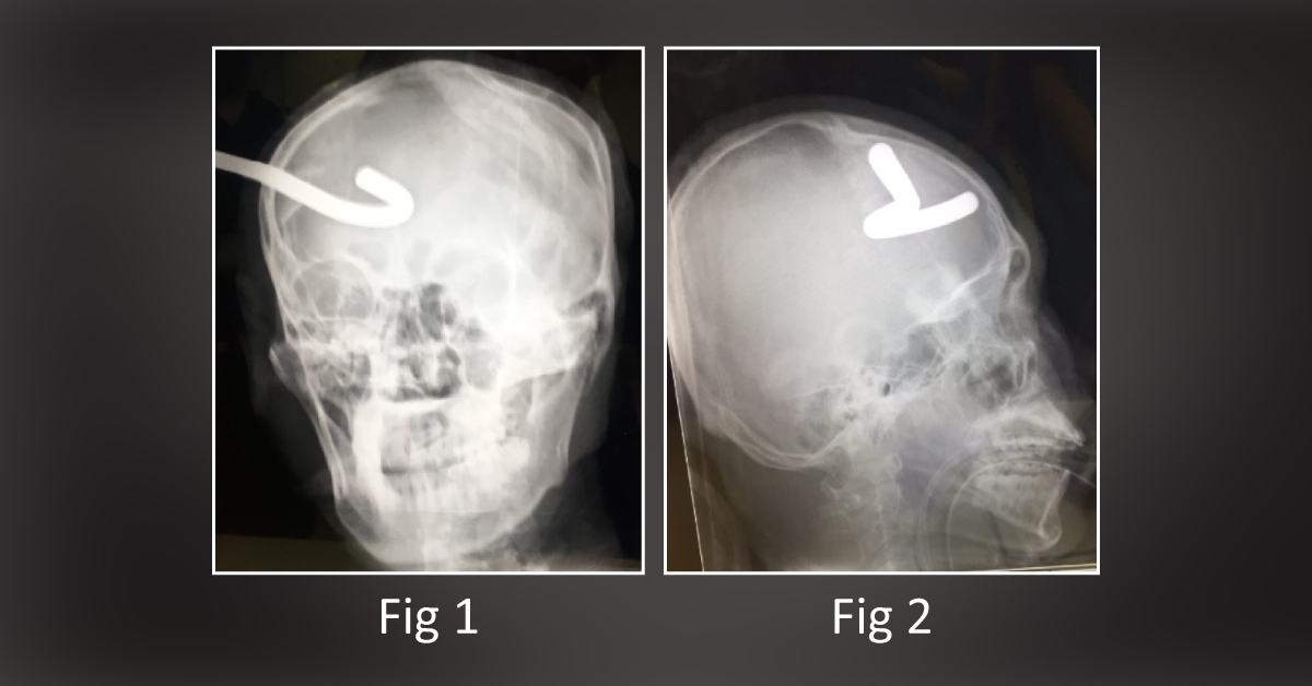 A Case of Impalement Brain Injury