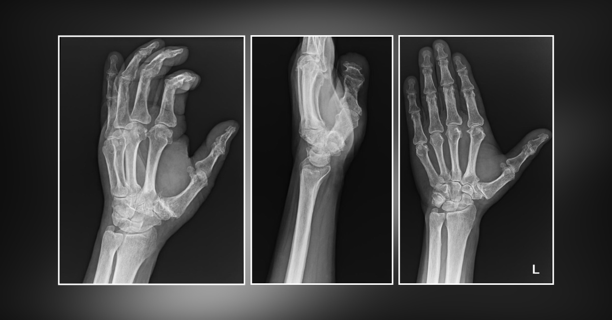 A Geriatric Man with Decreased Range of Motion in His Left Hand